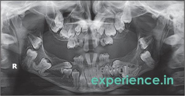 Unerupted Tooth(Children)